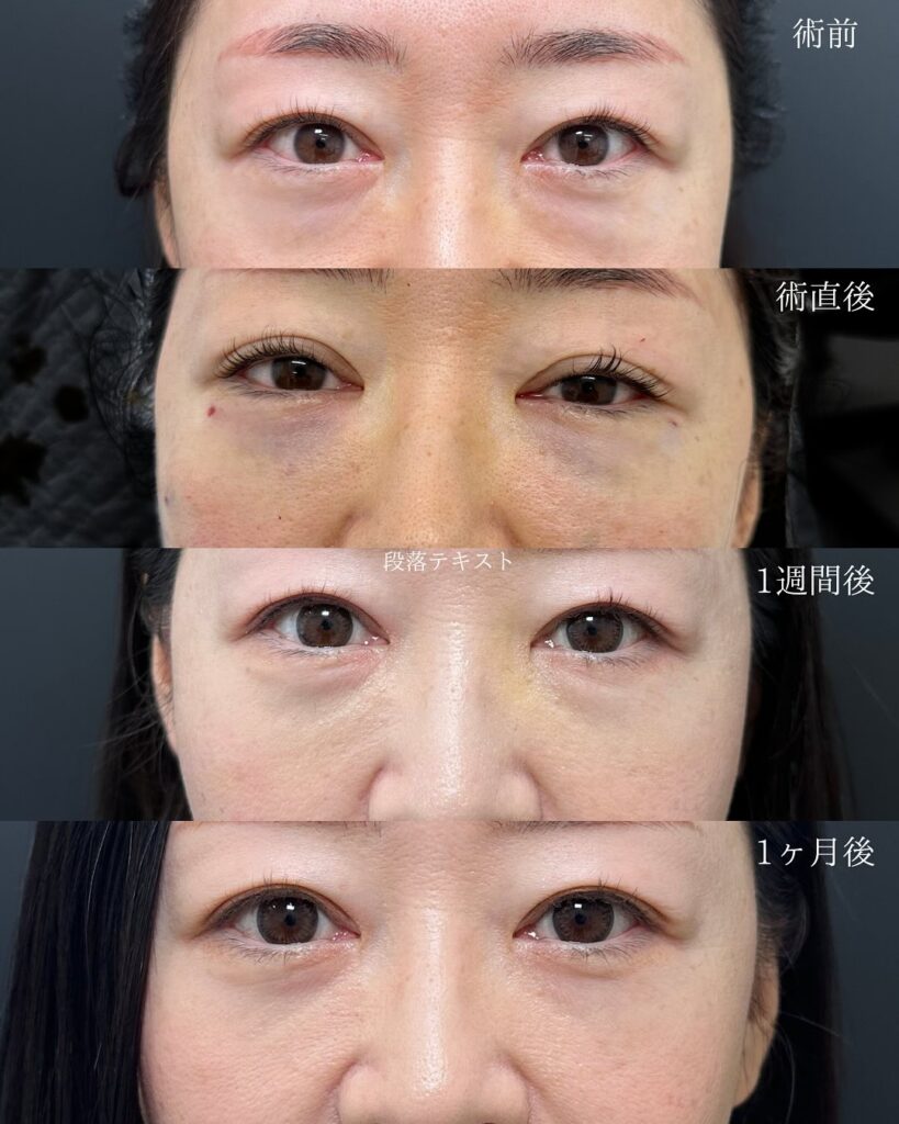 他院のクマ取り修正と脂肪注入と脱脂の症例写真 (2)