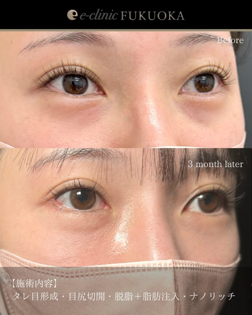 タレ目形成と目尻切開と脱脂と目の下の脂肪注入の症例写真 (4)