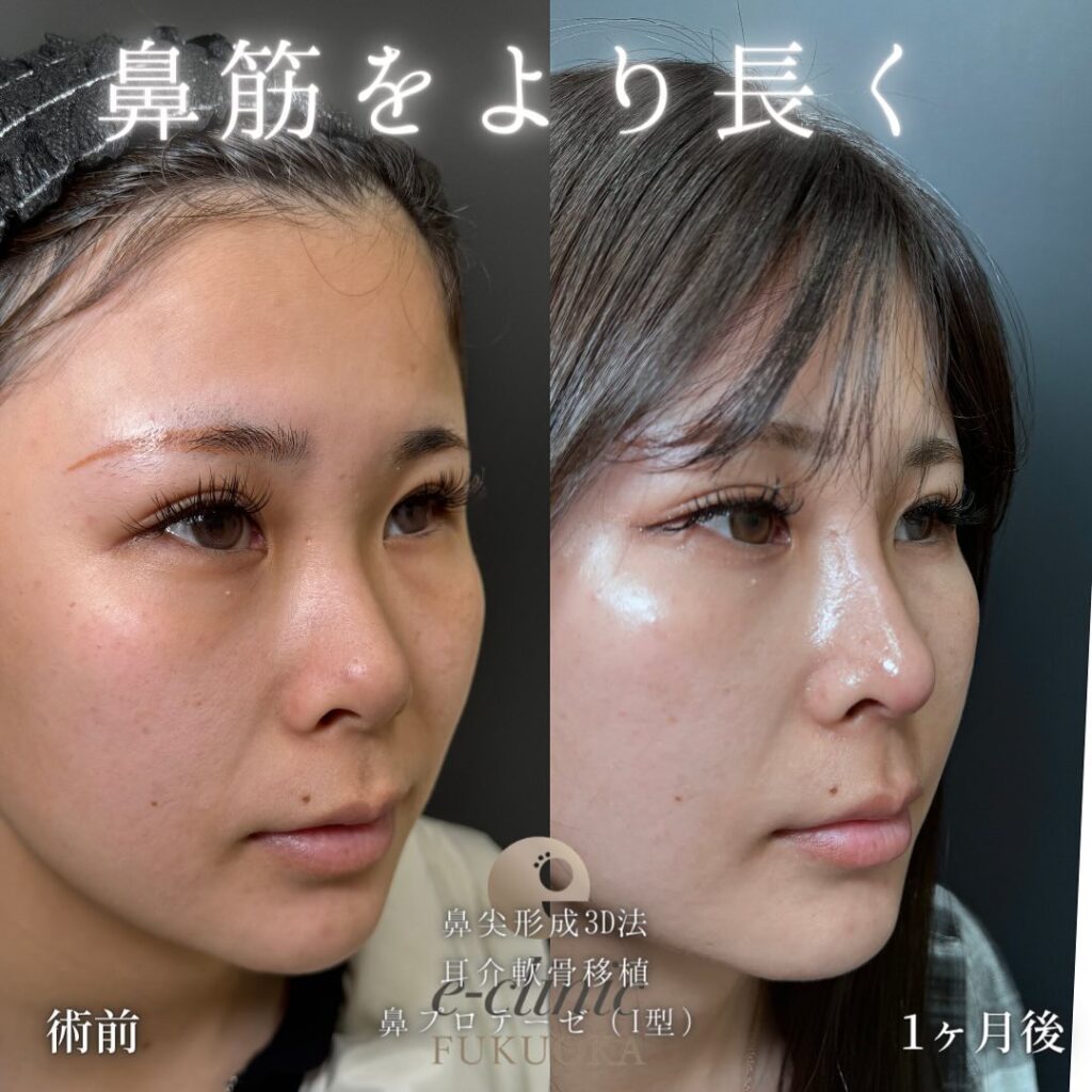 鼻尖形成と軟骨移植とプロテーゼの症例写真 (7)