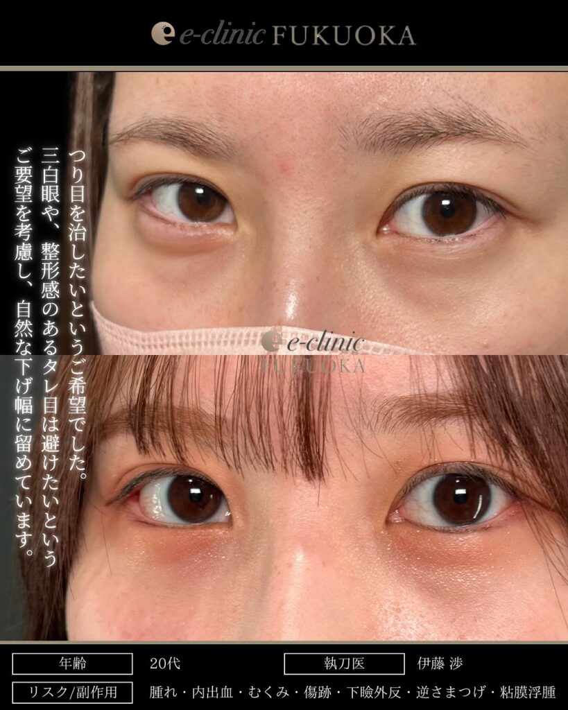 タレ目形成と目尻切開の症例写真 (11)