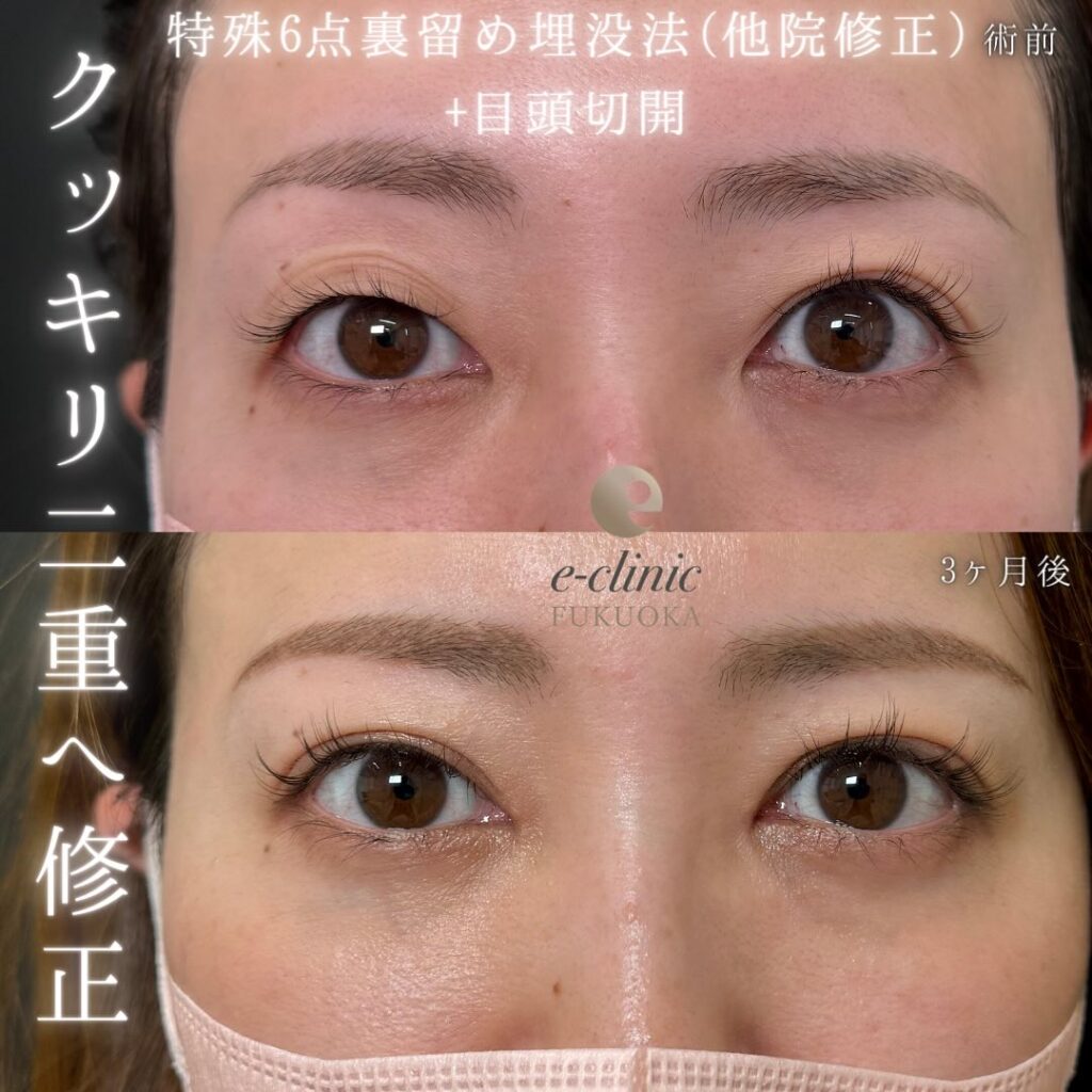 埋没法目元の他院修正と目頭切開の症例写真 (1)