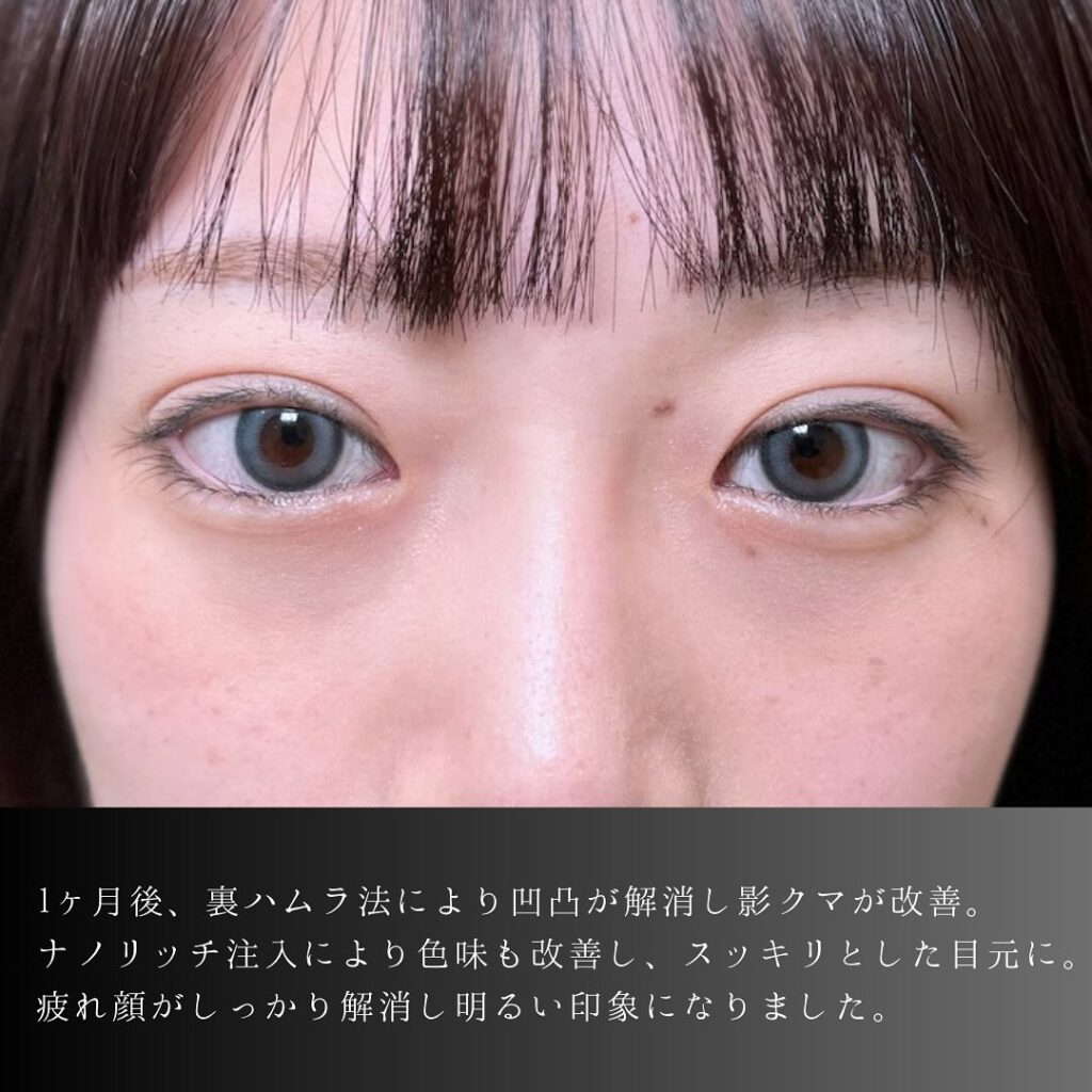 裏ハムラ法と脂肪注入の症例写真 (28)