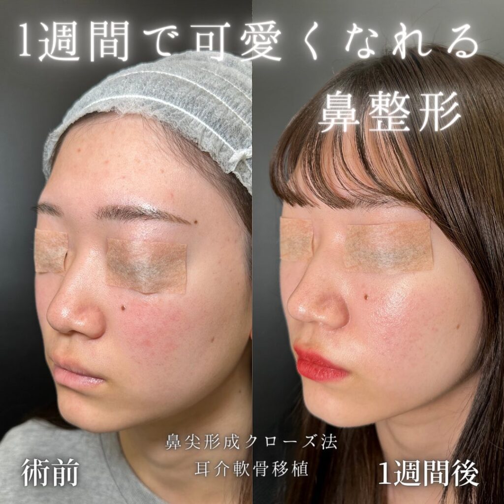 鼻尖形成と軟骨移植の症例写真 (1)