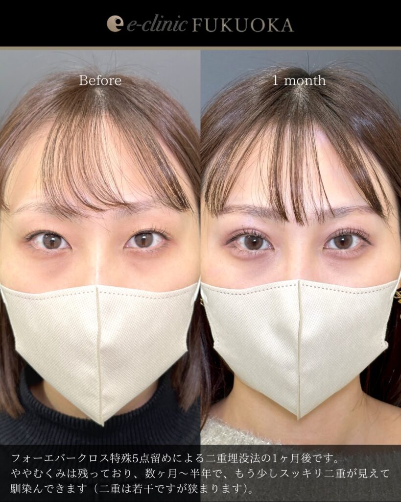 埋没法の症例写真 (18)