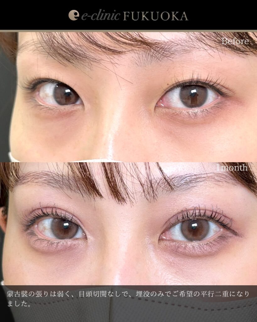 埋没法の症例写真 (17)