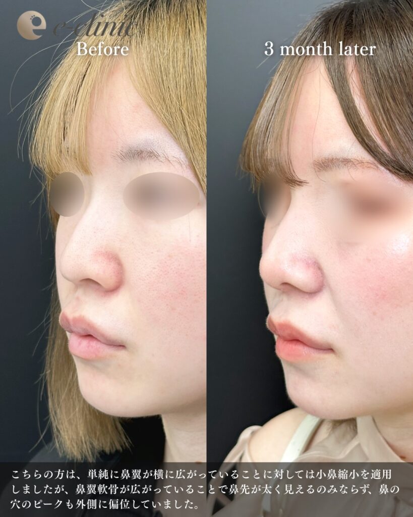 鼻尖形成と鼻中隔延長と耳介軟骨移植と小鼻縮小と鼻柱下降の症例写真 (6)