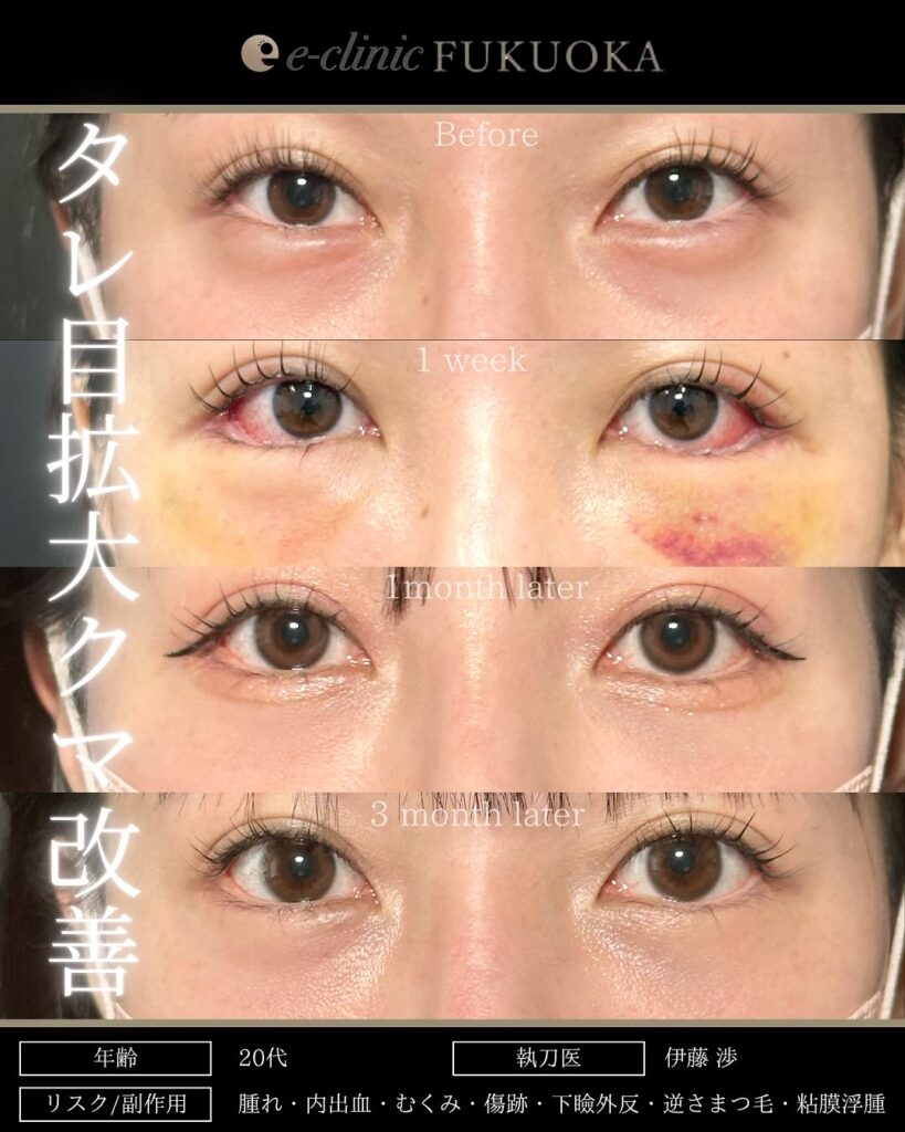 タレ目形成と目尻切開と脱脂と目の下の脂肪注入の症例写真 (1)