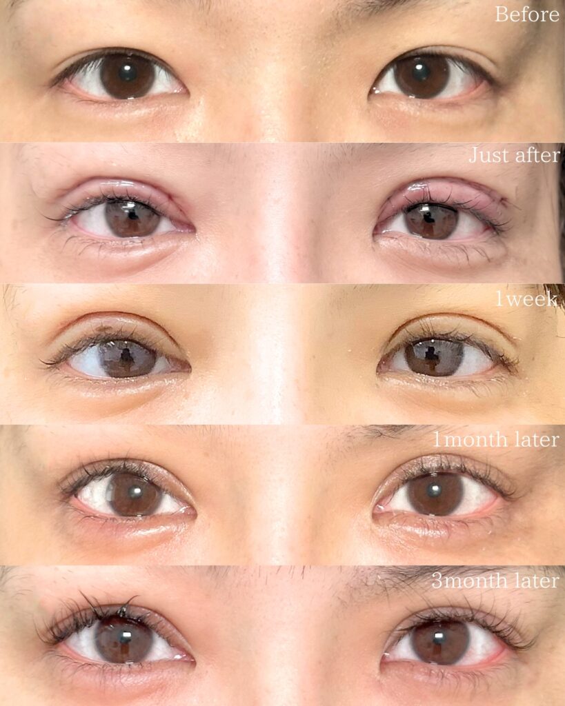 たるみとり併用全切開と眼瞼下垂と涙袋のヒアルロン酸の症例写真 (6)