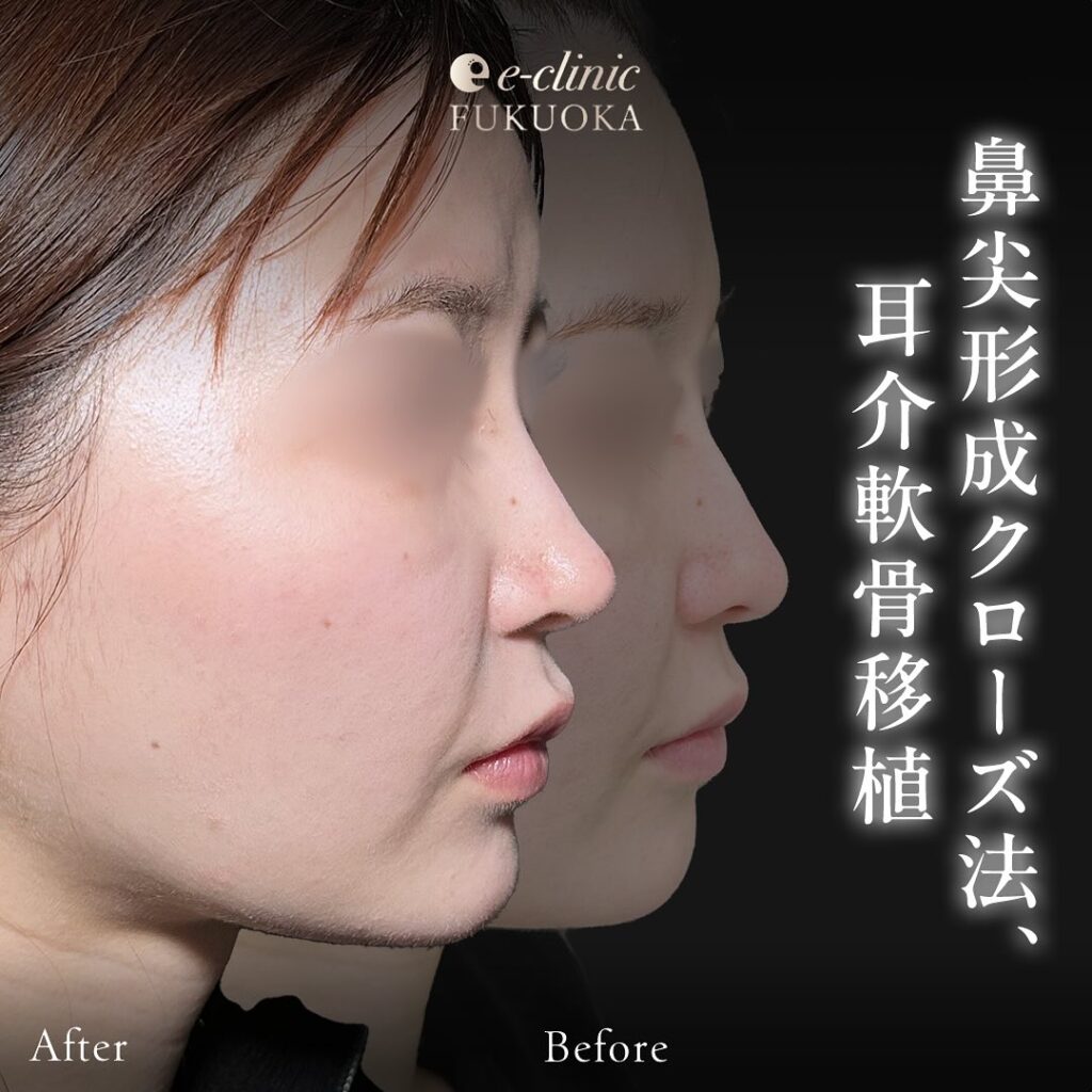 鼻尖形成と軟骨移植の症例写真 (12)