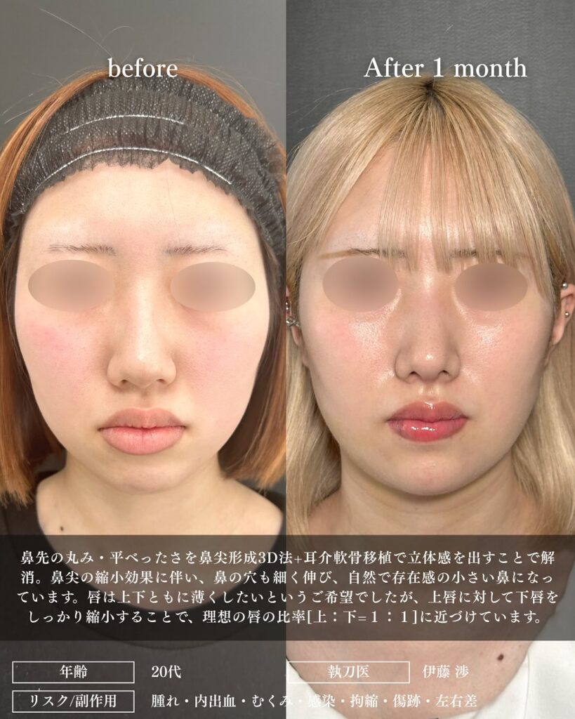 鼻尖形成と耳介軟骨移植と口唇縮小の症例写真 (2)