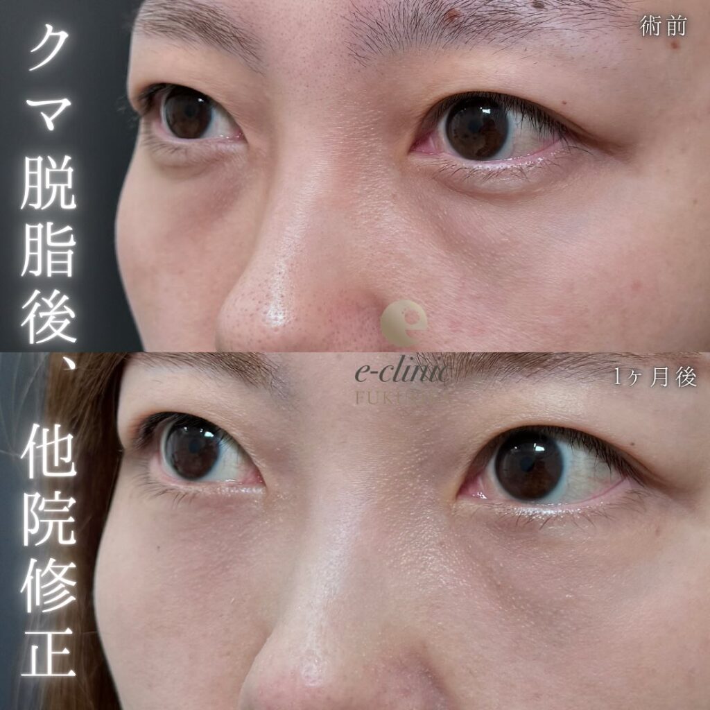 裏ハムラ法とナノリッチの症例写真 (11)