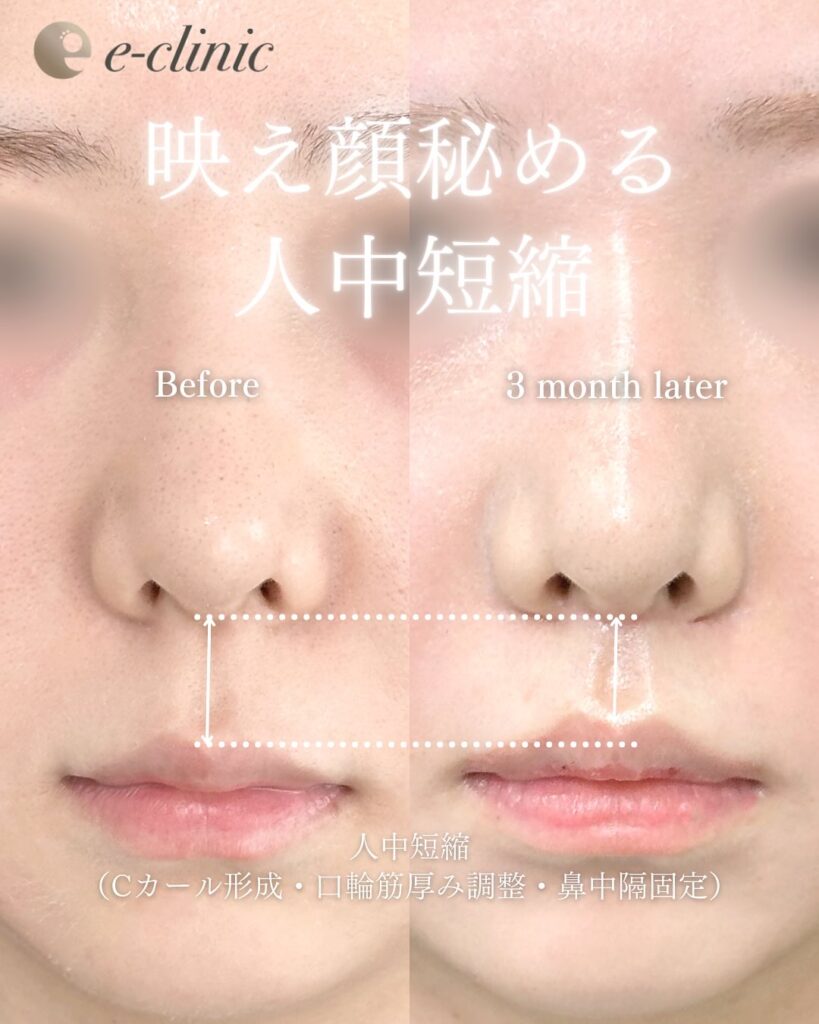 人中短縮の症例写真 (20)