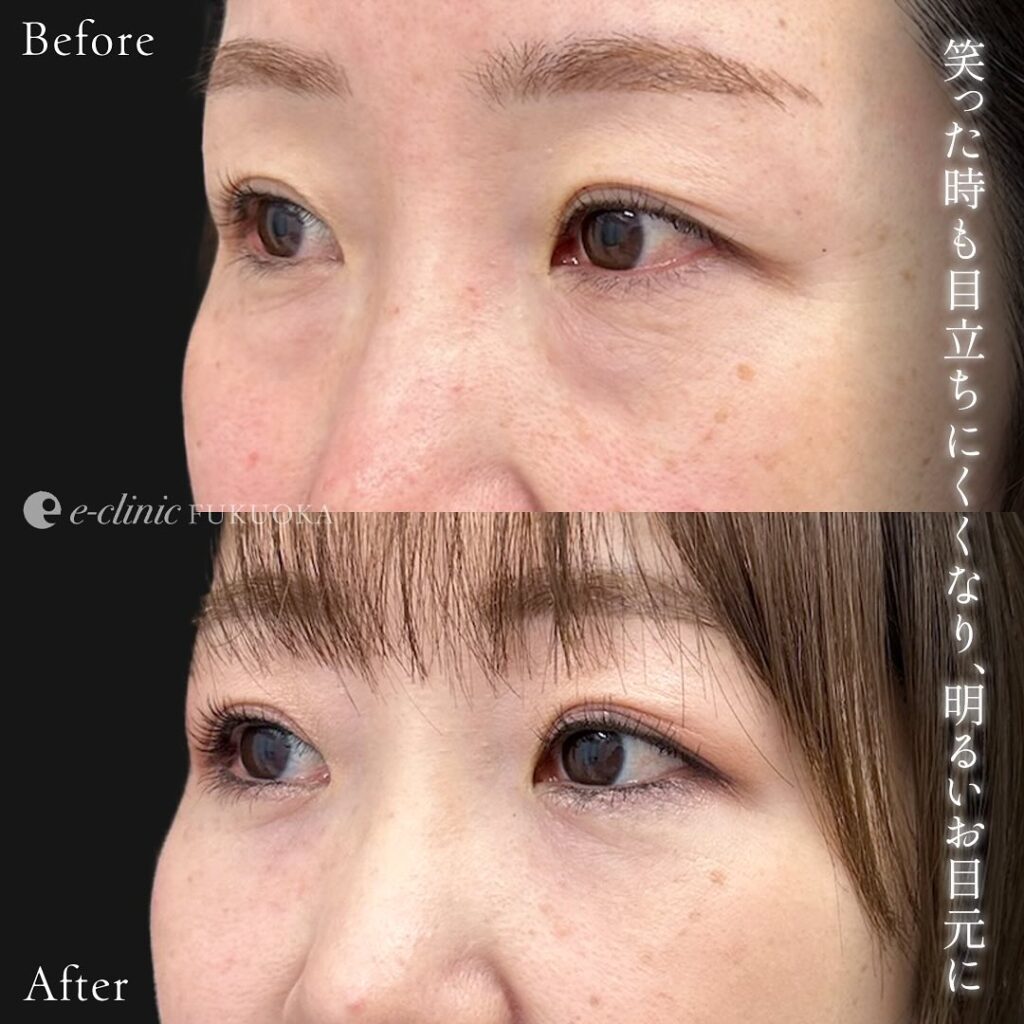 裏ハムラ法の症例写真 (89)