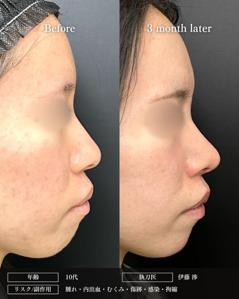 鼻尖形成と軟骨移植と小鼻縮小の症例写真 (36)