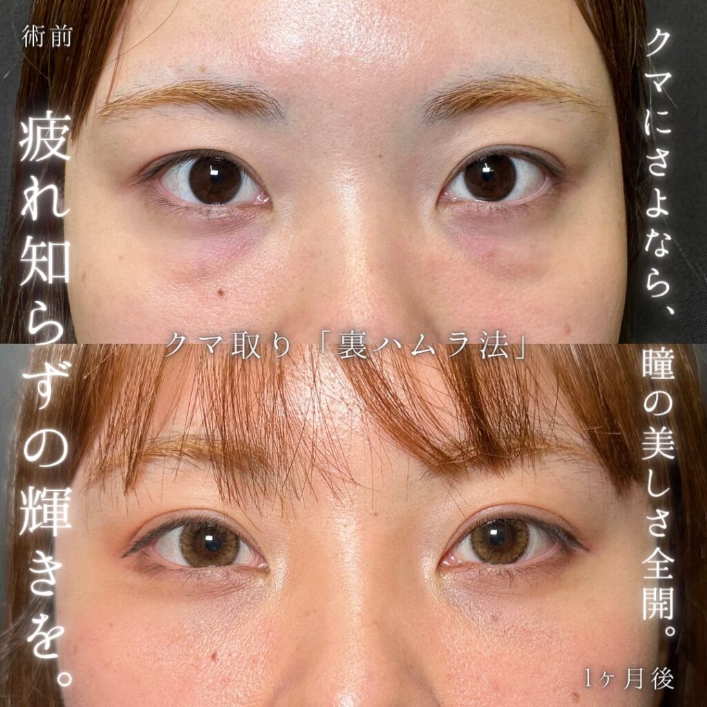 裏ハムラ法の症例写真 (35)