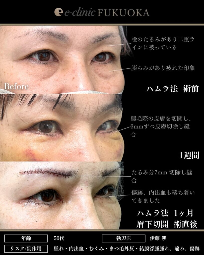 裏ハムラ法と眉下切開の症例写真 (6)