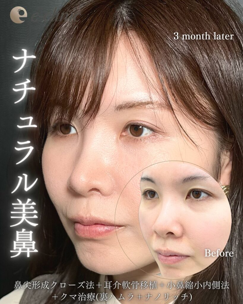 鼻尖形成と軟骨移植と小鼻縮小と裏ハムラ法と脂肪注入の症例写真 (4)
