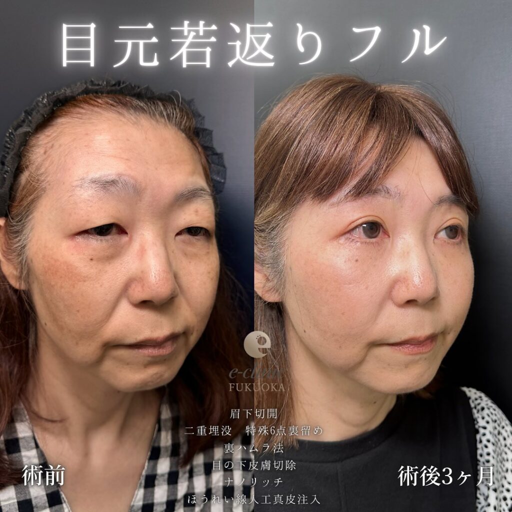 眉下切開と埋没法と裏ハムラ法と目の下の脂肪注入とほうれい線の脂肪注入の症例写真 (2)