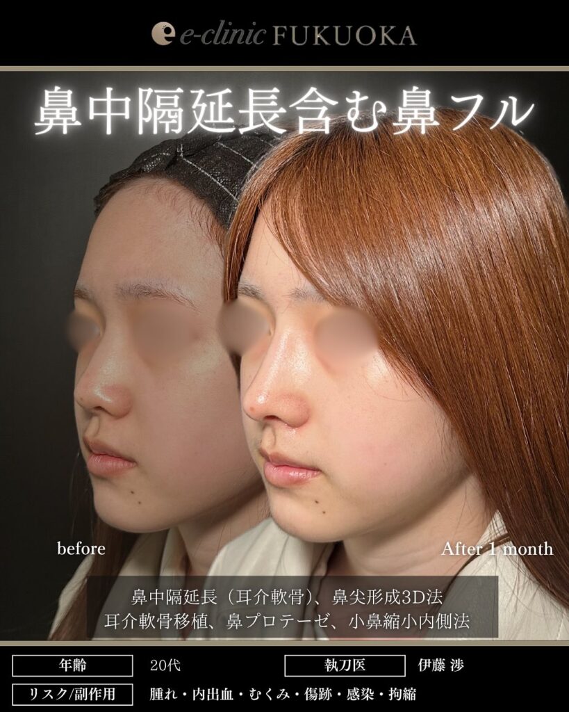 鼻中隔延長と鼻尖形成と耳介軟骨移植とプロテーゼと小鼻縮小の症例写真 (1)