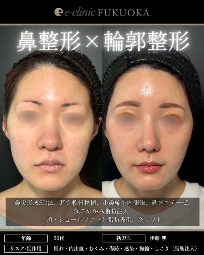 鼻尖形成と軟骨移植と小鼻縮小とプロテーゼと額の脂肪注入と頬の脂肪吸引とジョールファットと糸リフトの症例写真 (7)