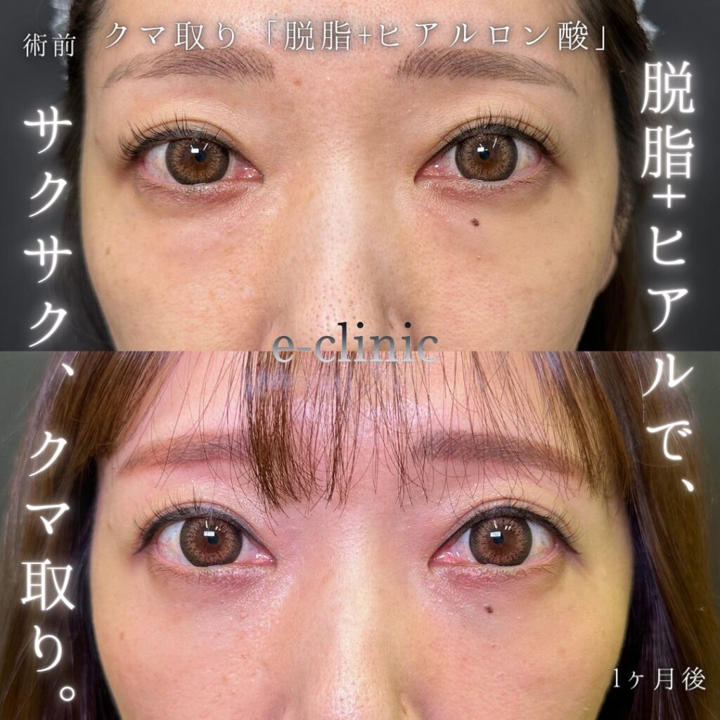 脱脂と目の下のヒアルロン酸の症例写真 (4)