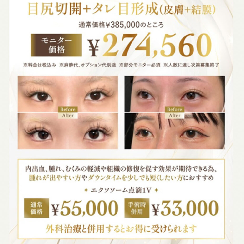 目尻、タレ目形成キャンペーン