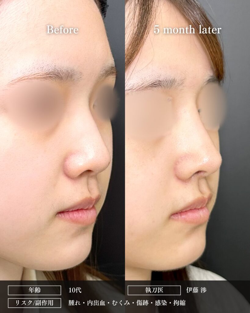 鼻中隔延長と鼻尖形成と耳介軟骨とプロテーゼと小鼻縮小と小鼻ボトックスの症例写真 (4)