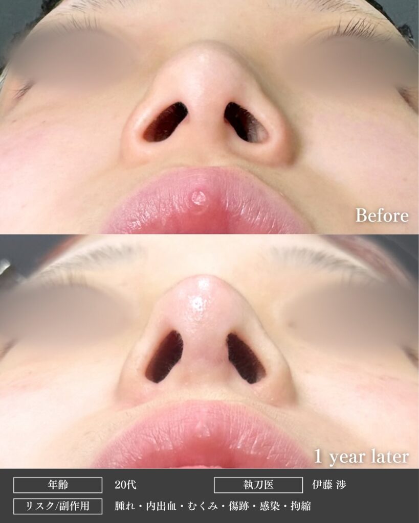 鼻尖形成と軟骨移植と小鼻縮小の症例写真 (32)