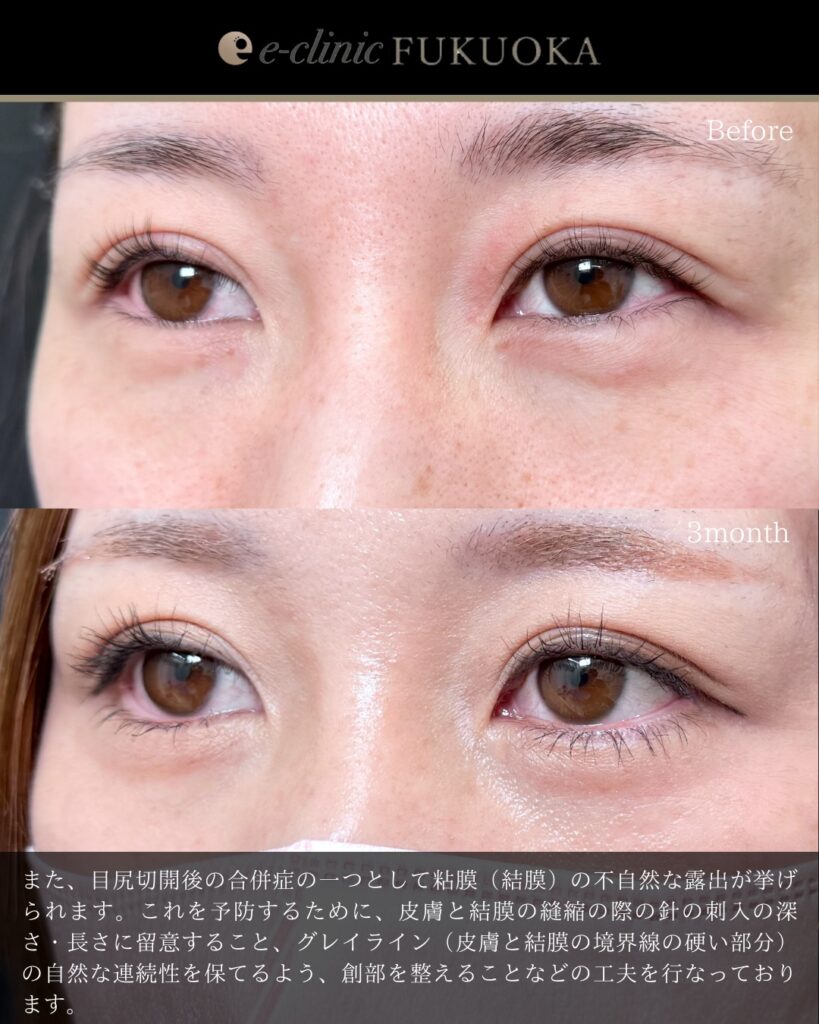 タレ目形成と目尻切開と脱脂とクマ取りの症例写真 (3)