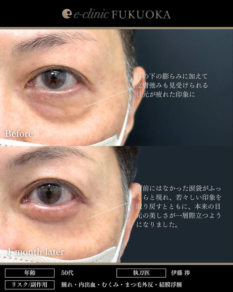 裏ハムラ法とナノリッチとボトックスの症例写真 (4)