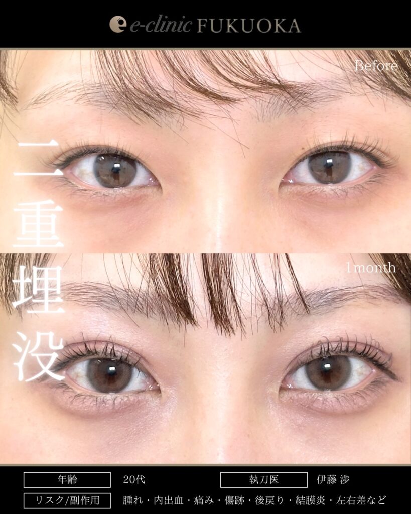 埋没法の症例写真 (12)