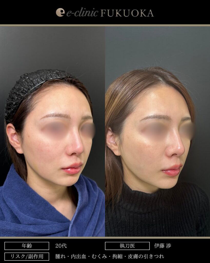 頬と顎下の脂肪吸引とジョールファットとバッカルファットと糸リフトの症例写真 (2)