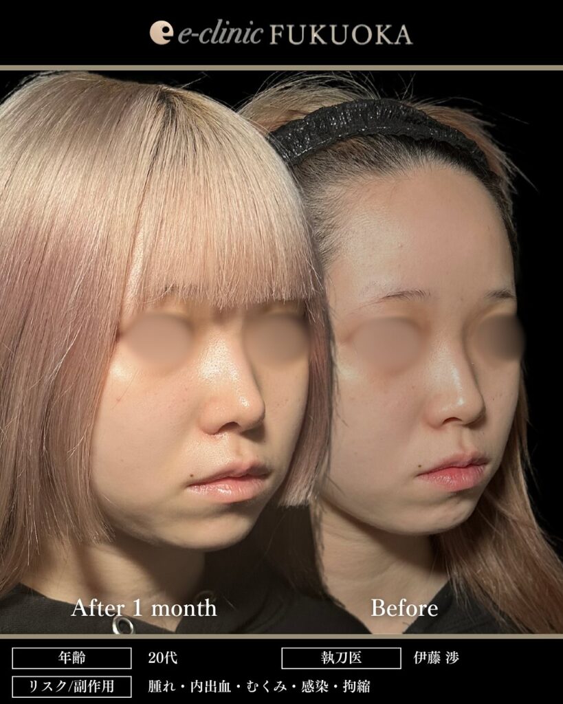 鼻尖形成と軟骨移植と小鼻縮小の症例写真 (18)