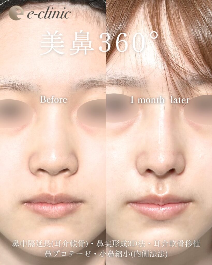 鼻尖形成と鼻中隔延長と耳介軟骨移植とプロテーゼと小鼻縮小の症例写真 (1)