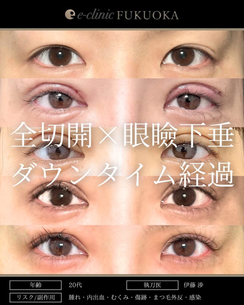 たるみとり併用全切開と眼瞼下垂と涙袋のヒアルロン酸の症例写真 (1)