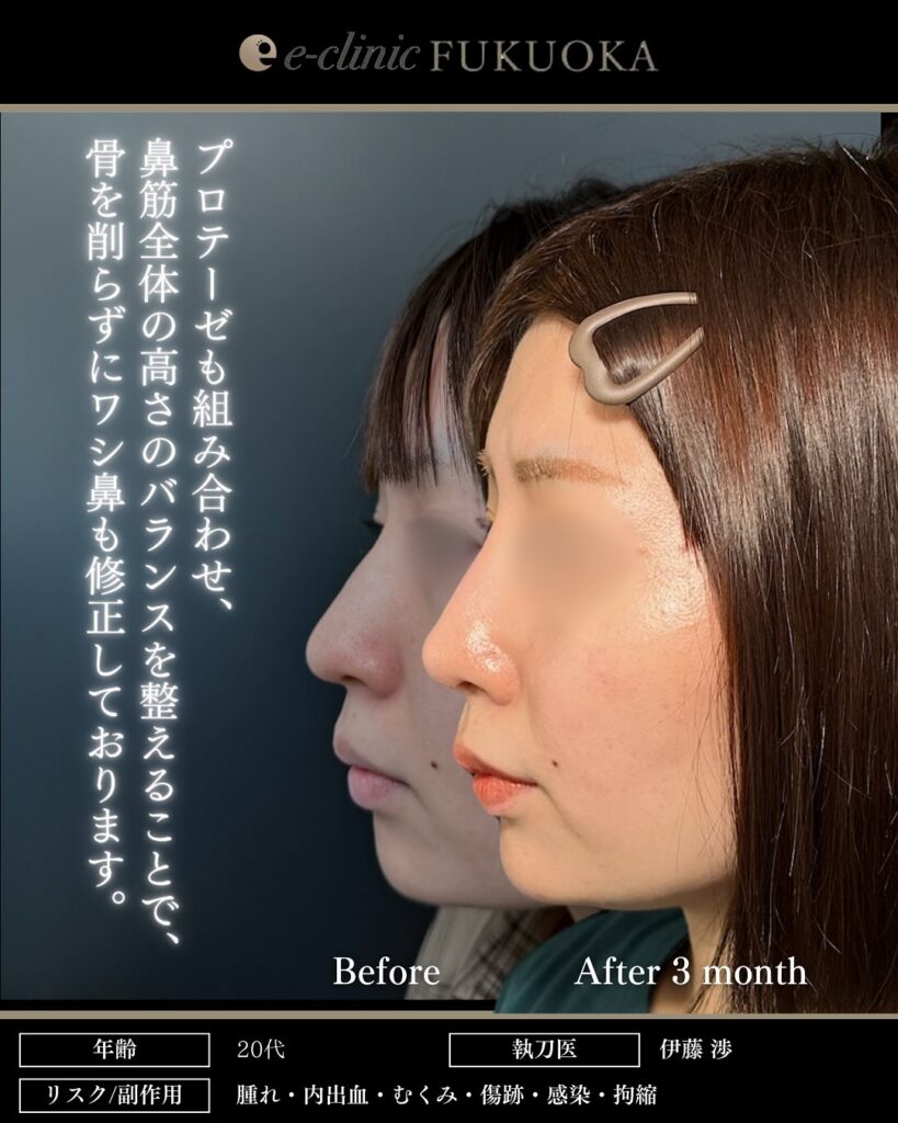 鼻尖形成と耳介軟骨移植とプロテーゼと小鼻縮小の症例写真 (2)