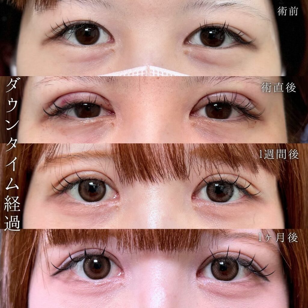 たるみ取り併用全切開の症例写真 (4)