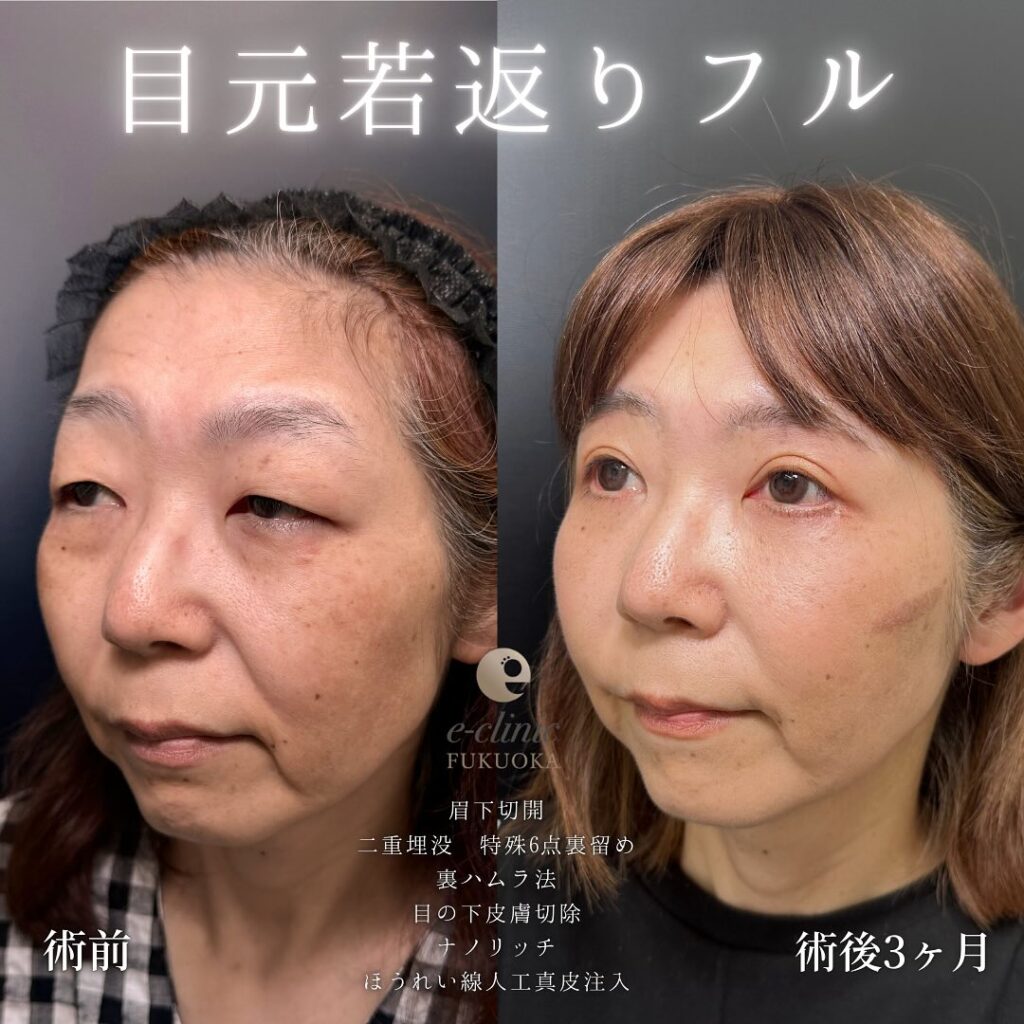 眉下切開と埋没法と裏ハムラ法と目の下の脂肪注入とほうれい線の脂肪注入の症例写真 (3)