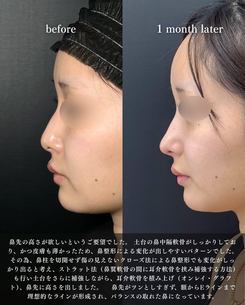 鼻尖形成と軟骨移植の症例写真 (43)