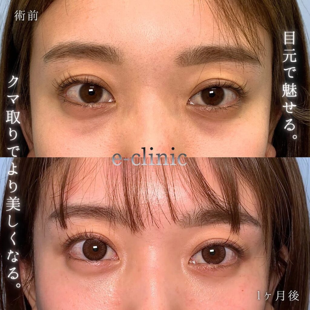 裏ハムラ法の症例写真 (16)