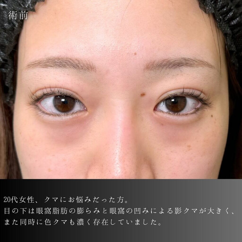 裏ハムラ法と脂肪注入の症例写真 (29)