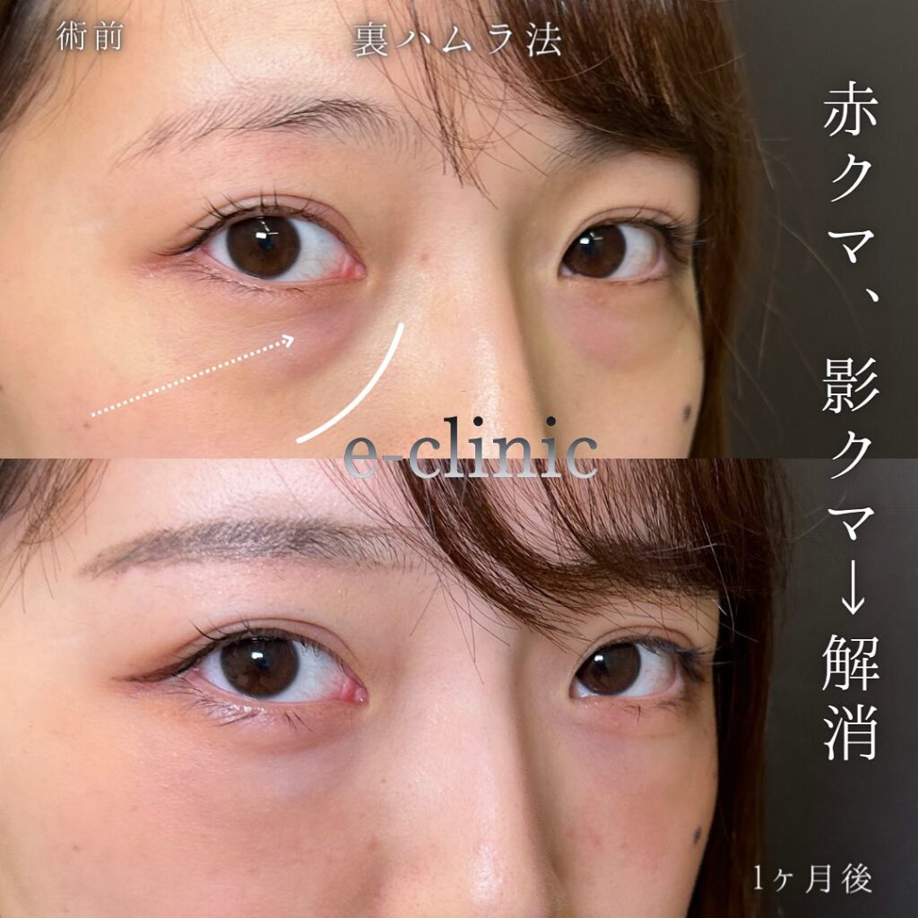 裏ハムラ法の症例写真 (50)