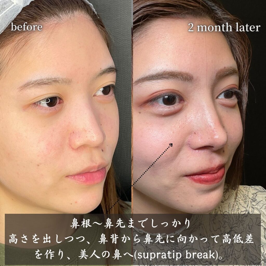 鼻中隔延長と鼻尖形成と耳介軟骨移植とプロテーゼと他院修正の症例写真 (9)