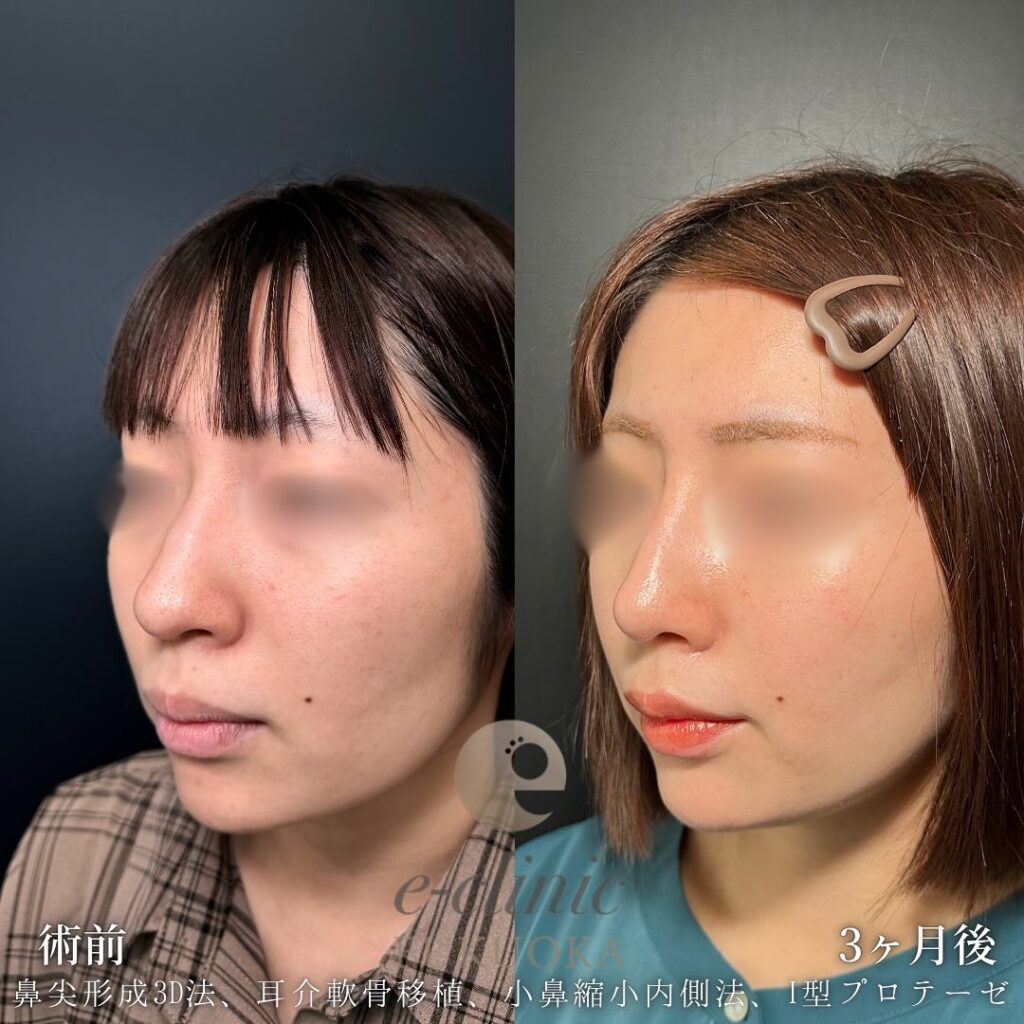 鼻尖形成と軟骨移植と小鼻縮小とプロテーゼの症例写真 (6)