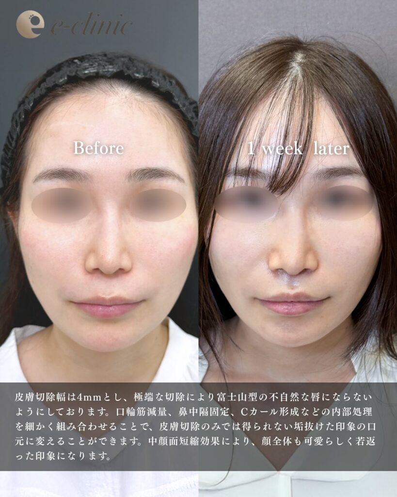 人中短縮の症例写真 (19)