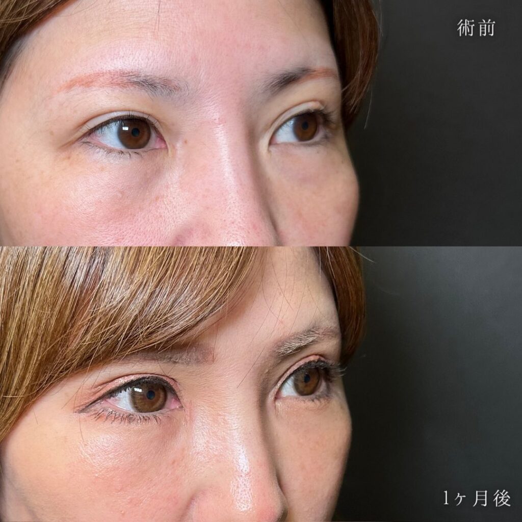 目の全方向拡大とクマ取りの症例写真 (3)