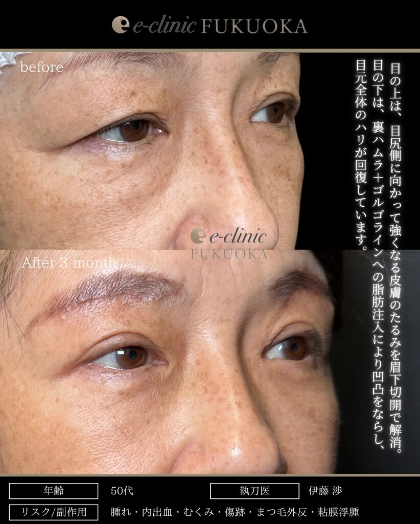 眉下切開と裏ハムラ法と目の下の脂肪注入の症例写真 (3)
