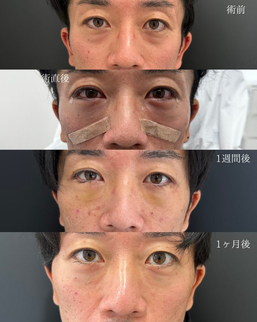 裏ハムラ法と脂肪注入の症例写真 (34)