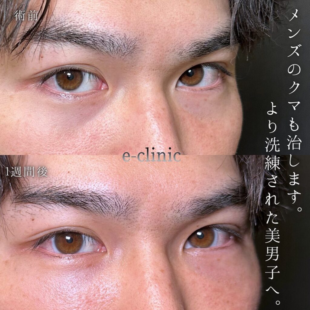 脱脂と脂肪注入の症例写真 (2)