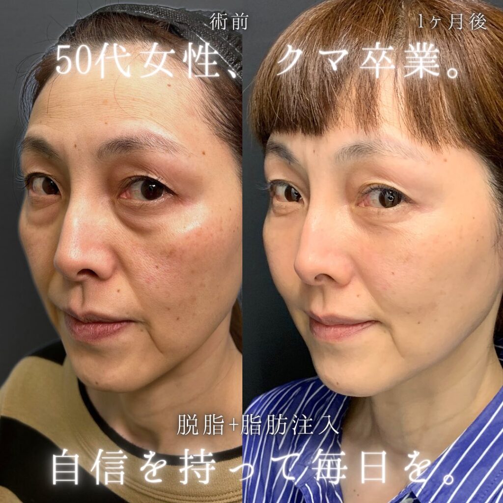 脱脂と脂肪注入の症例写真 (5)